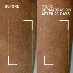 Dr. Brandt Microdermabrasion Hydrating Body Exfoliator - Renews Rough, Dull, Dry & Bumpy Skin - 4.2 oz