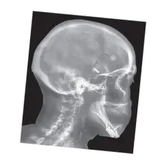 Roylco Broken Bones X-Rays