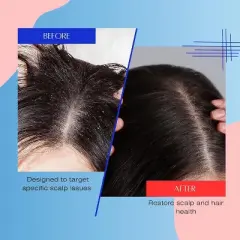 Mediceuticals X-Folate Persistent Dandruff & Psoriasis Treatment Shampoo | Clear and Healthy Scalp | Soothes and Reduces Itchiness - (8.45 oz)