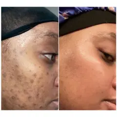 Urban Skin Rx 3-in-1 Even Tone Travel Size Facial Cleansing Bar - 1oz