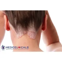 Mediceuticals X-Folate Persistent Dandruff & Psoriasis Treatment Shampoo | Soothes and Reduces Itchiness | Clear and Healthy Scalp - (33.8 oz)