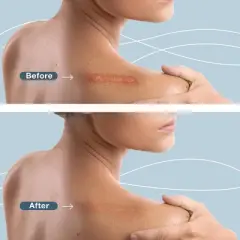 Silicone Scar Sheets, Scar Tape for Surgical Scars, 120" x 1.6" Roll - C-Section, Tummy Tuck, Keloid Scar Treatment, As Post Surgical Cream, Gel