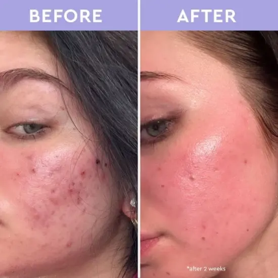 Florence by mills Spot A Spot Acne Exfoliating Solution - 5 fl oz - Ulta Beauty image {2}