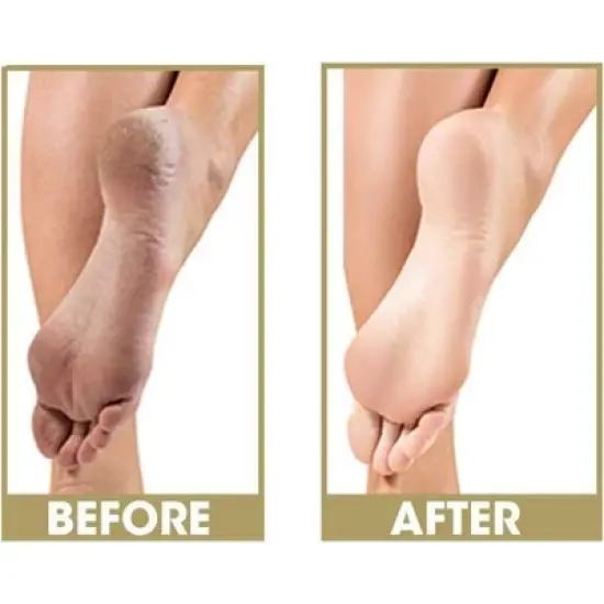 Be Natural by ProLinc Callus Eliminator (18 oz XXL) Fast Acting Formula | Professional Quality | No Drip & Easy Application image {1}