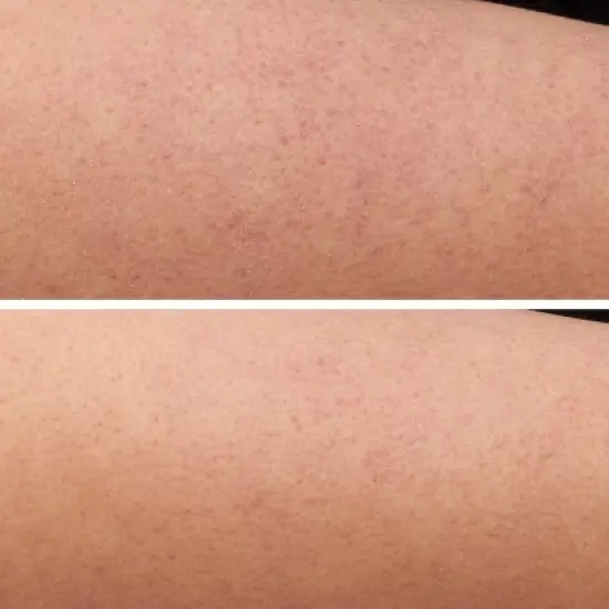 Strivectin KP Care Bump Exfoliating Body Scrub - 5 oz - Ulta Beauty image {4}