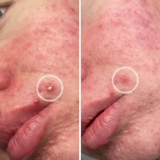 ZitSticka Goo Getter Surface Pimple Hydrocolloid Patch - 36ct image {5}