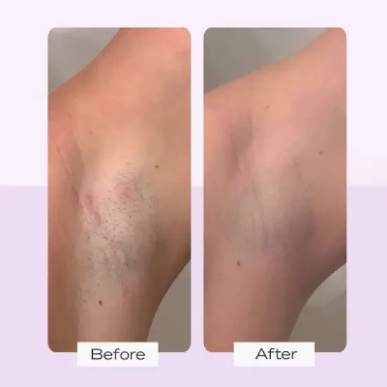 FIRST AID BEAUTY Ingrown Hair Pads - 28ct - Ulta Beauty image {4}