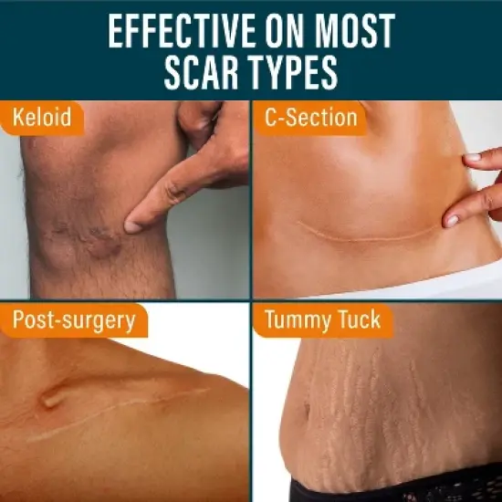 Nuvadermis Silicone Scar Tape for Kids' - Dino Pattern - 60" Roll image {3}