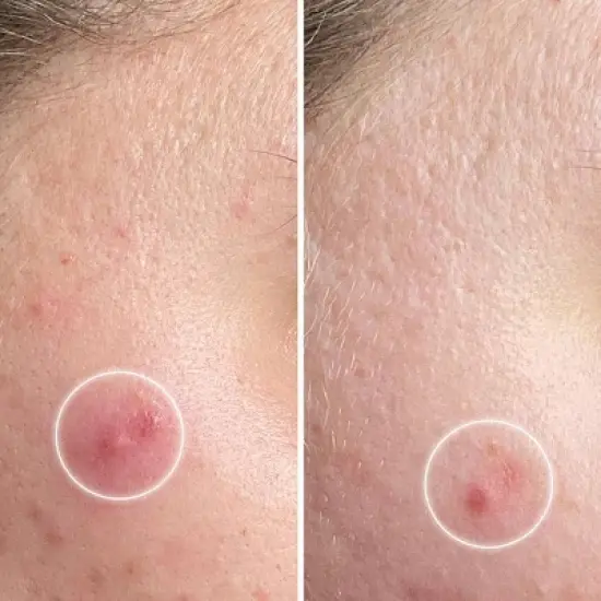 ZitSticka Killa Deep Zit Microdart Pimple Patch - 4pk image {6}