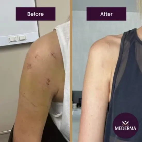 Mederma Advanced Scar Gel 1.76 Oz image {3}