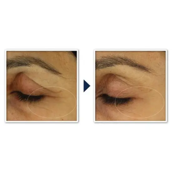 RoC Retinol Correxion Line Smoothing Anti-Aging Wrinkle Eye Cream for Dark Circles & Puffy Eyes - 0.5 fl oz image {8}