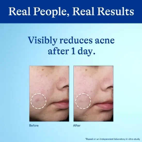 Differin 10% Benzoyl Peroxide Acne Spot Treatment image {5}