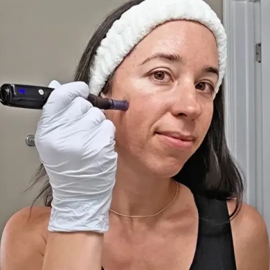 Beautimate Microneedle Pen &ndash; Adjustable At-Home Microneedling Device for Fine Lines, Wrinkles, and Firmer Skin image {11}