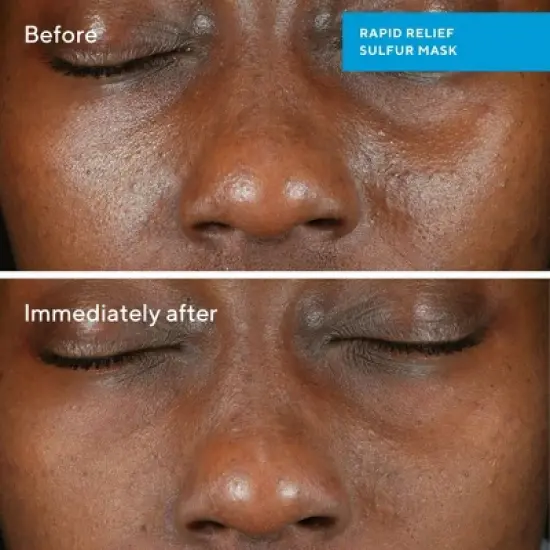 Murad Rapid Relief Acne Sulfur Mask - 2.5fl oz - Ulta Beauty image {3}