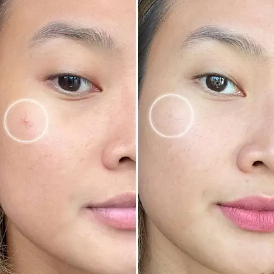 ZitSticka Killa Deep Zit Microdart Pimple Patch - 4pk image {5}