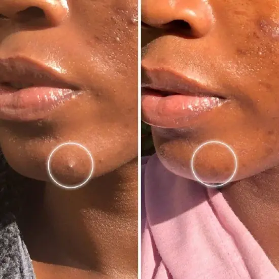 ZitSticka Goo Getter Surface Pimple Hydrocolloid Patch - 36ct image {4}