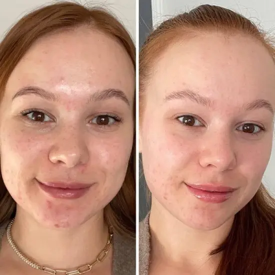 ZitSticka Pore Vac Clearing Clay Face Mask - 2.03 fl oz image {7}