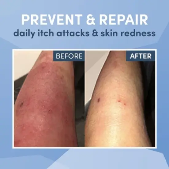 AD Rescue Wear Eczema Clothing for Kids - Arm and Leg Sleeves for Girls and Boys - Itch Relief, Ultra-Soft (Large 8-10 In) image {6}