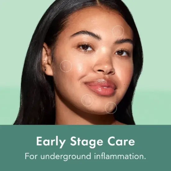 Rael Beauty Miracle Pimple Patch Microcrystal Spot Cover for Acne image {3}