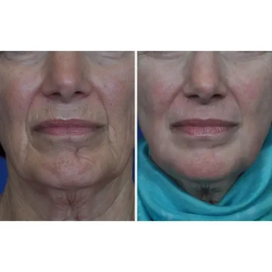 LINSAY Rejuvenation - Lifting Facial Device EMS Technology Anti-aging Warm/Cool LED Massager image {4}