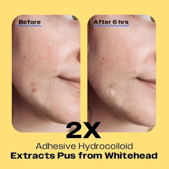 Avarelle Cosmetics ZITOUT Invisible Hydrocolloid Pimple Patch with Tea Tree, Calendula and Rosehip Seed Oil, Vegan, Korean Skincare, 2-sizes, 24 ct image {1}