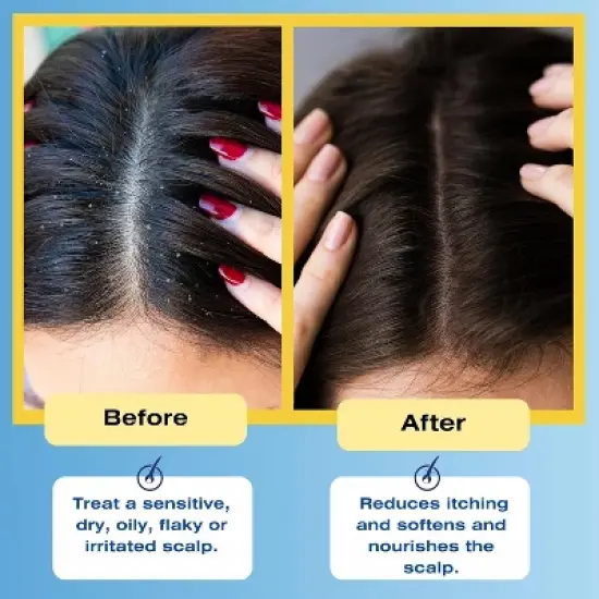 Mediceuticals Therapeutic Scalp & Hair Treatment Rinse | Reduce Itching | Soothing Scalp | Healthy Scalp | Scalp Protection - (8.45 oz) image {3}