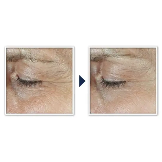 RoC Derm Correxion Dual Eye Cream - 0.68 fl oz image {6}