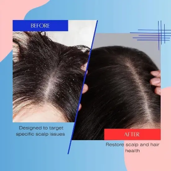 Mediceuticals X-Folate Persistent Dandruff & Psoriasis Treatment Shampoo | Clear and Healthy Scalp | Soothes and Reduces Itchiness - (8.45 oz) image {1}