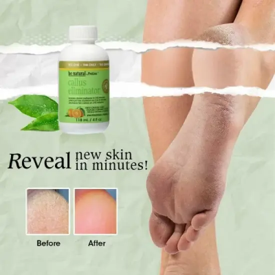 Be Natural by ProLinc Callus Eliminator (18 oz XXL) Fast Acting Formula | Professional Quality | No Drip & Easy Application image {2}