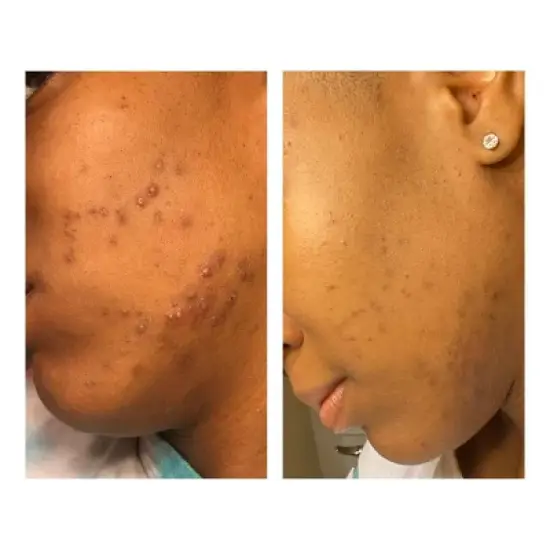 ROSEN Skincare Tropics Moisturizer for Texture and Scarring - 2 fl oz image {5}