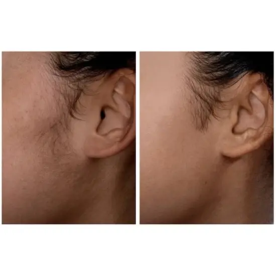 Spa Sciences SIMA Deluxe Sonic Dermaplaning Tool for Exfoliation & Peach Fuzz Removal image {9}