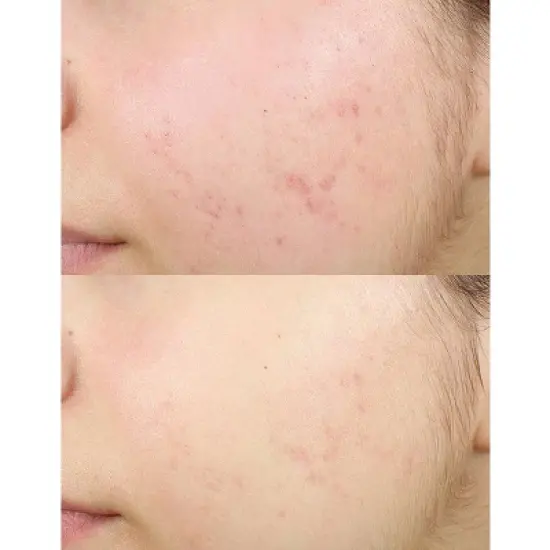 derma e Anti-Acne Oil Control Matte Moisturizer &ndash; 2oz image {5}