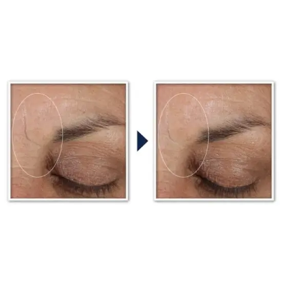 RoC Deep Wrinkle Retinol Patches - 6ct image {6}