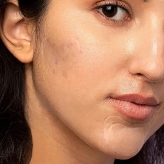 Rael Beauty Miracle Pimple Patch Spot Control Cover for Acne image {4}