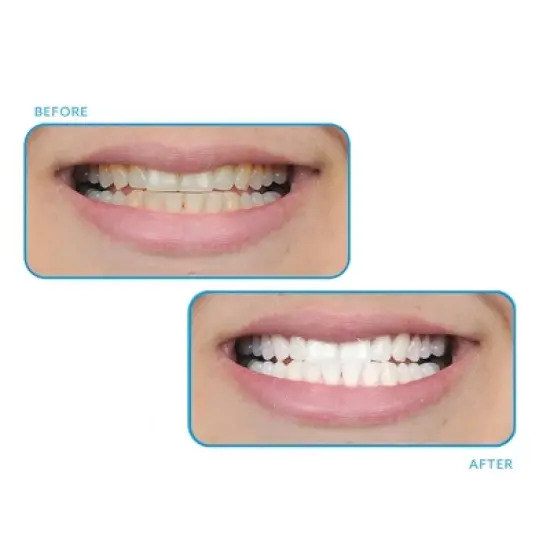 GO SMILE Tooth Whitening System - 0.04 fl oz image {2}