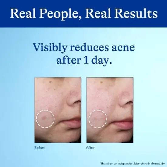 Differin 10% Benzoyl Peroxide Acne Spot Treatment image {10}