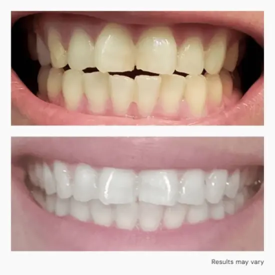 Snow Diamond Series Wired Whitening Starter Kit image {7}