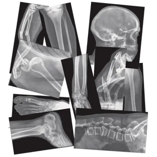 Roylco Broken Bones X-Rays image {4}