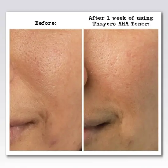 Thayers Natural Remedies 2% AHA Exfoliating Toner - 12 fl oz image {4}