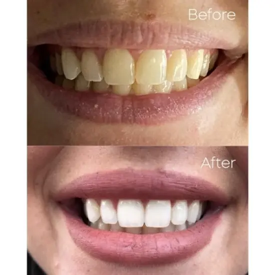 PurelyWHITE DELUXE Whitening Kit Refills image {5}