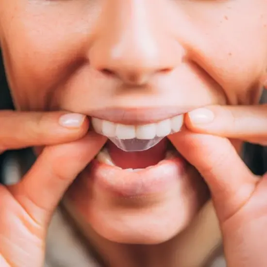 Professional Teeth Whitening Strips image {2}