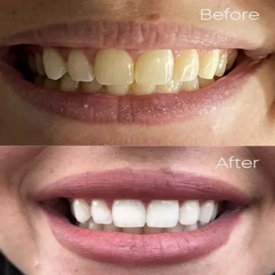 PurelyWHITE DELUXE | Whitening Strips image {5}