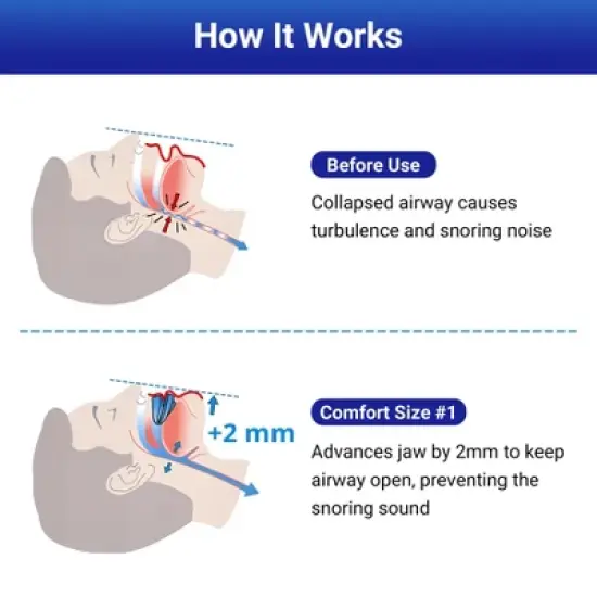 YEVYO Anti-Snoring Mouthpiece - Mouth Guard Device with +2mm Jaw Adjustment, Breathable Anti Snoring Solution for Men & Women - Includes Case - Blue image {2}