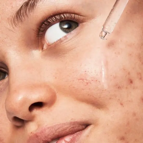 e.l.f. Blemish Breakthrough Triple-Acid Resurfacing Serum - 0.94 fl oz image {2}