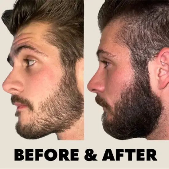 Beard Club Beard Derma Roller image {2}