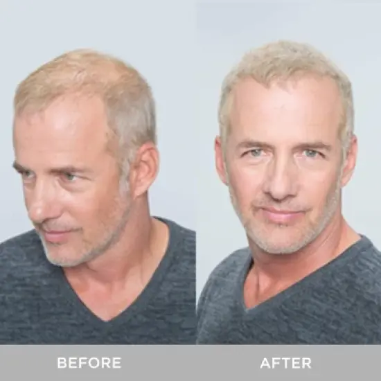 XFusion Keratin Hair Fibers (0.98 oz XXL Large Size) - DARK BROWN | Appearance of Naturally Thick, Full Hair by Toppik X Fusion image {2}