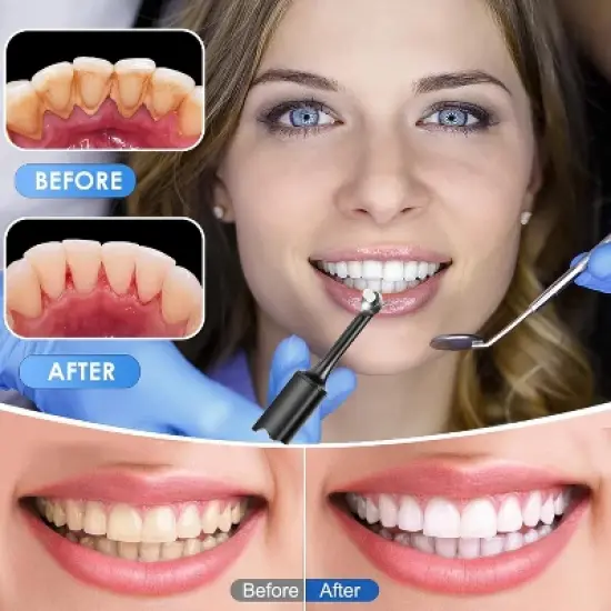 YEVYO 4 Mode Tooth Polisher - 5 Replaceable 360&deg; Dental Polishing Heads with LED?Lighted Cleaning Tool, IPX6 Waterproof Teeth Polishing Kit - Black image {7}