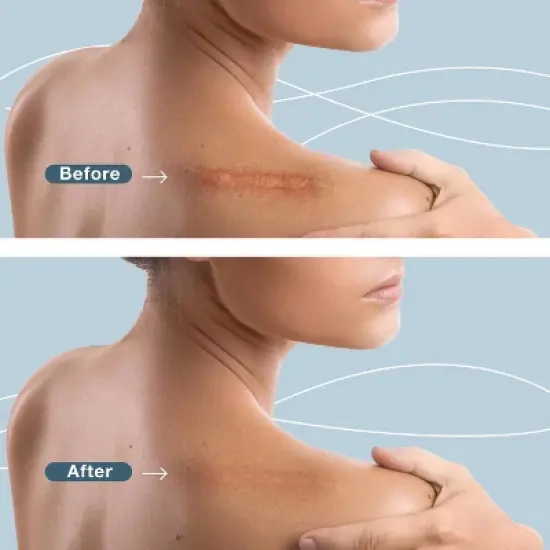 Silicone Scar Sheets, Scar Tape for Surgical Scars, 120" x 1.6" Roll - C-Section, Tummy Tuck, Keloid Scar Treatment, As Post Surgical Cream, Gel image {1}