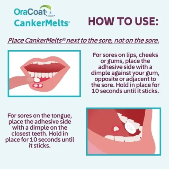 OraCoat Stick-On Melts Mouth Sore Treatment Canker Melts - 15mg Benzocaine - 20ct image {3}
